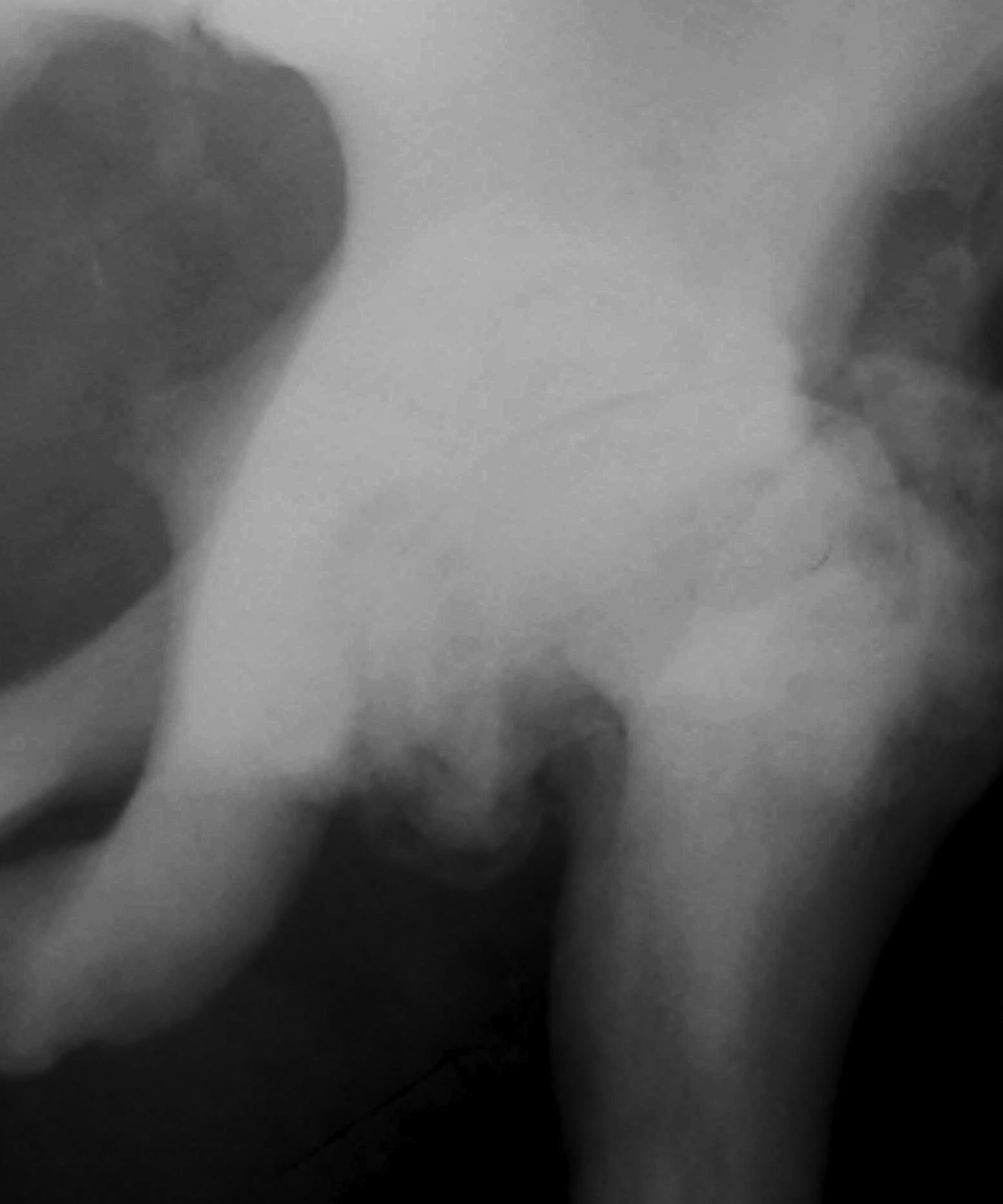 Hip Osteopetrosis OA